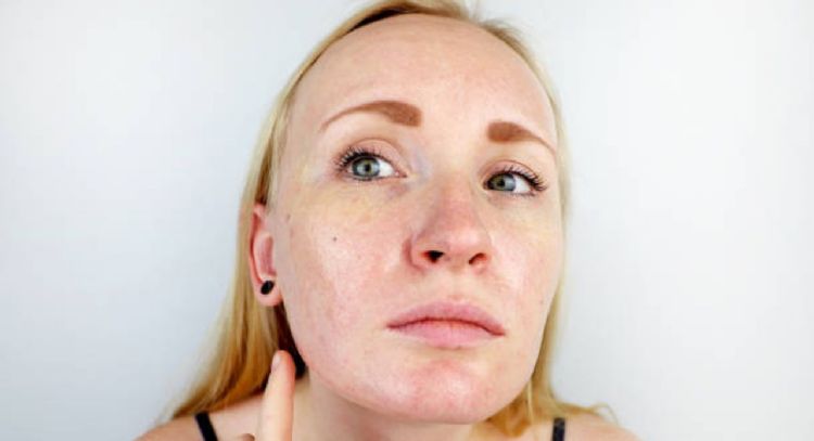 Cómo eliminar la grasa de la piel preparando un tónico casero con solo 3 ingredientes