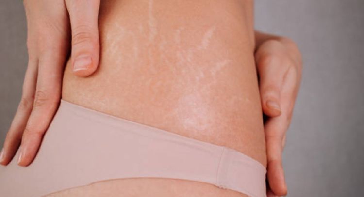 Dile adiós a las estrías con estos 2 remedios caseros que pocos conocen