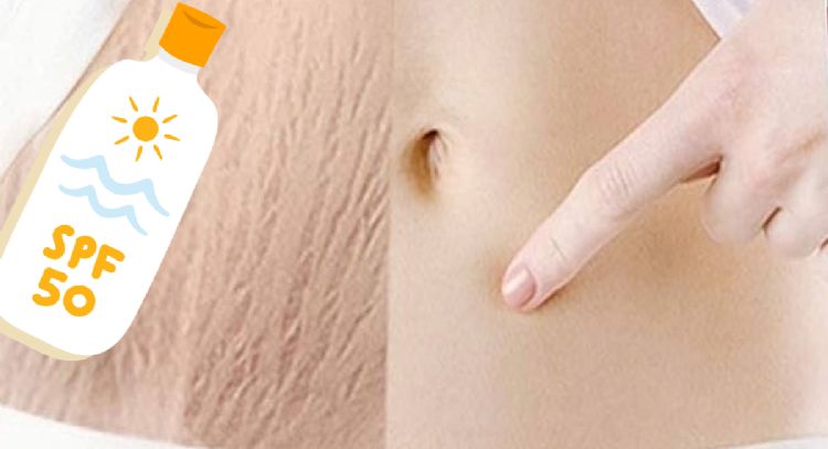 Dile adiós a las estrías con esta poderosa crema desde el primer uso