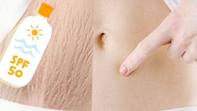 Dile adiós a las estrías con esta poderosa crema desde el primer uso