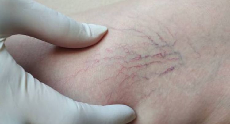 Dile adiós a las várices con solo 3 ingredientes de cocina