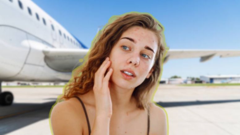Se confirmó el daño en la piel que producen los viajes en avión y los cuidados que debes tener