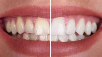 3 ingredientes para quitar la placa y el sarro de los dientes