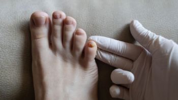 Cómo eliminar los hongos en las uñas de los pies