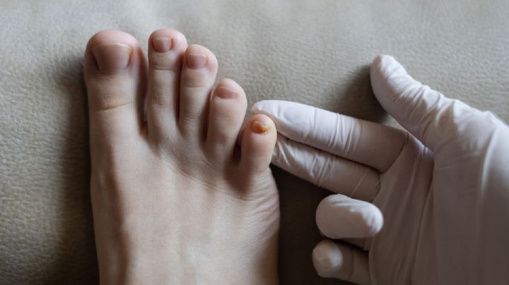 Cómo eliminar los hongos en las uñas de los pies