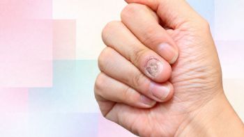 Qué hacer si tus uñas están llenas y con hongos luego de usar semipermanente