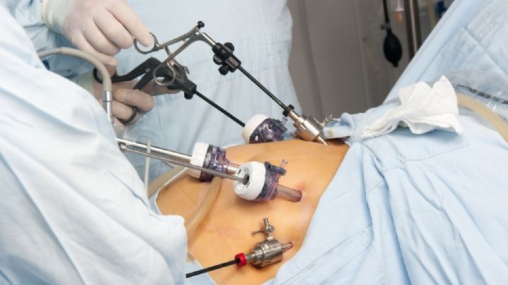 Operación estética de U$S 45.000 es furor en Colombia: de qué se trata y qué problemas puede causar